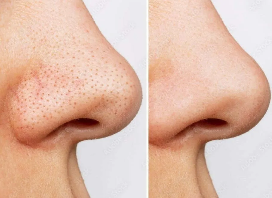 How To Get Rid Of Blackheads On The Nose Vanity