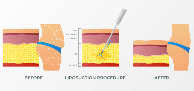 vanity liposuction turkey