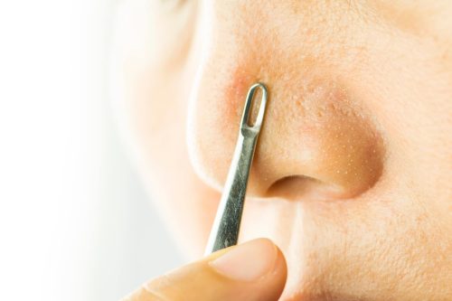 How To Get Rid Of Blackheads On The Nose Vanity