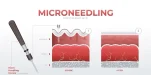 gold_rf_microneedling_3