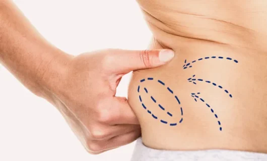 liposuction-01.webp liposuction-01.webp