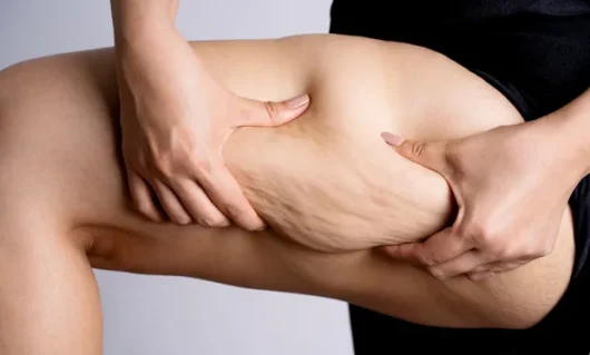 liposuction-03.webp liposuction-03.webp