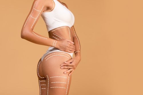liposuction in turkey vanity