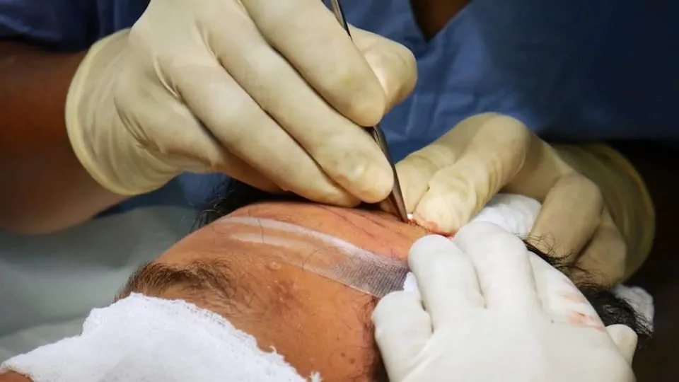 Saç ekim operasyonu