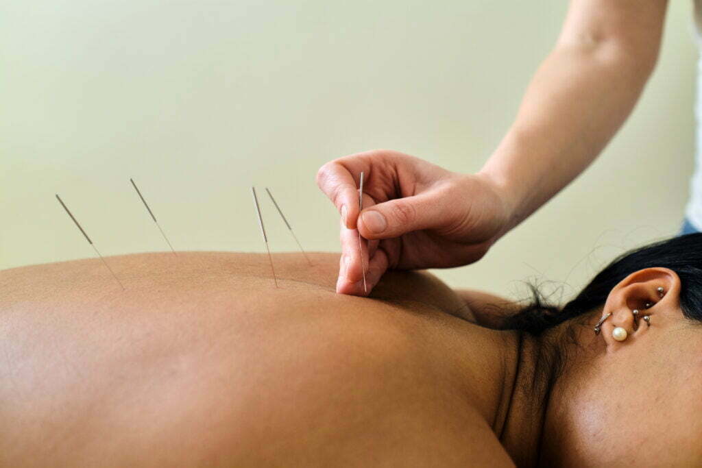 Acupuncture