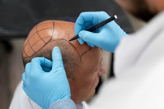 DHI-vanity-hair-transplant
