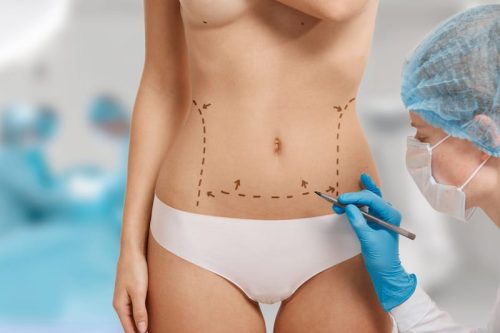 Tummy Tuck Surgery in Turkey Vanity