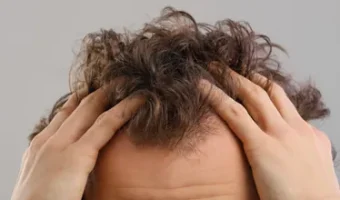 services-hair-transplant