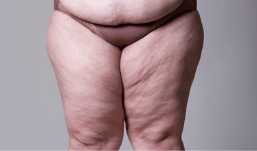 services-leg-thigh-lift